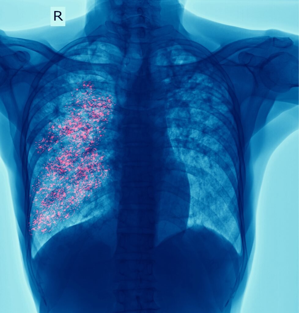 Radiografía de tórax con una representación de una lesión en el pulmón derecho